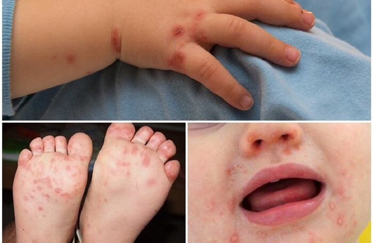 Sau khi khỏi chân tay miệng, trẻ nhỏ có nguy cơ gặp phải các biến chứng