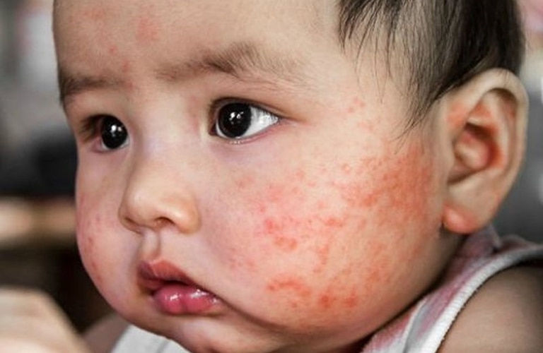 Trẻ bị nổi mẩn đỏ xung quanh miệng có thể là dấu hiệu của bệnh chàm sữa