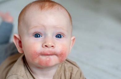 Nguyên nhân trẻ bị nổi mẩn đỏ xung quanh miệng và cách điều trị hiệu quả