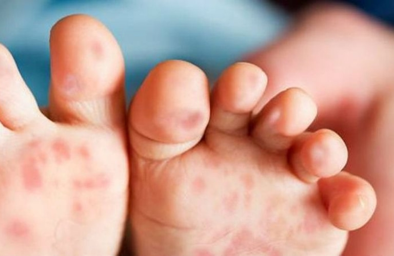 Có nhiều nguyên nhân khiến trẻ sơ sinh bị nổi mẩn đỏ ở chân các phụ huynh cần lưu ý