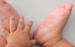 Trẻ sơ sinh bị nổi mẩn đỏ ở chân cảnh báo bệnh gì? Nguy hiểm không?