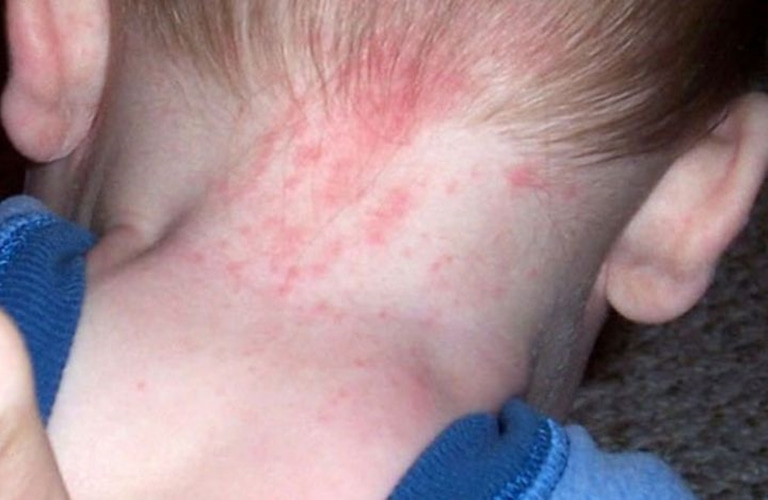 Trẻ sơ sinh bị nổi mẩn đỏ ở cổ kèm vảy ở rìa xung quanh có thể là dấu hiệu của bệnh chàm sữa