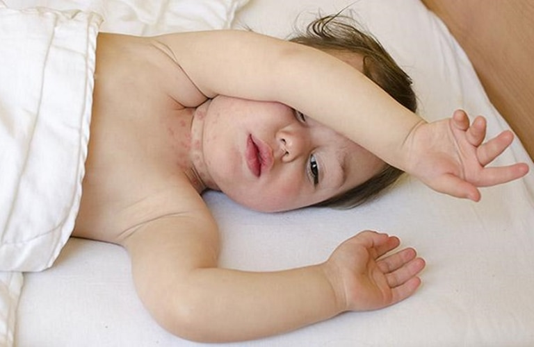 Biểu hiện của viêm da tiết bã là là da nổi mẩn đỏ nhưng không gây ngứa, khó chịu cho trẻ