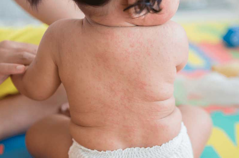 Trẻ sơ sinh nổi mẩn đỏ ở lưng không có triệu chứng khác đi kèm sẽ không quá nguy hiểm