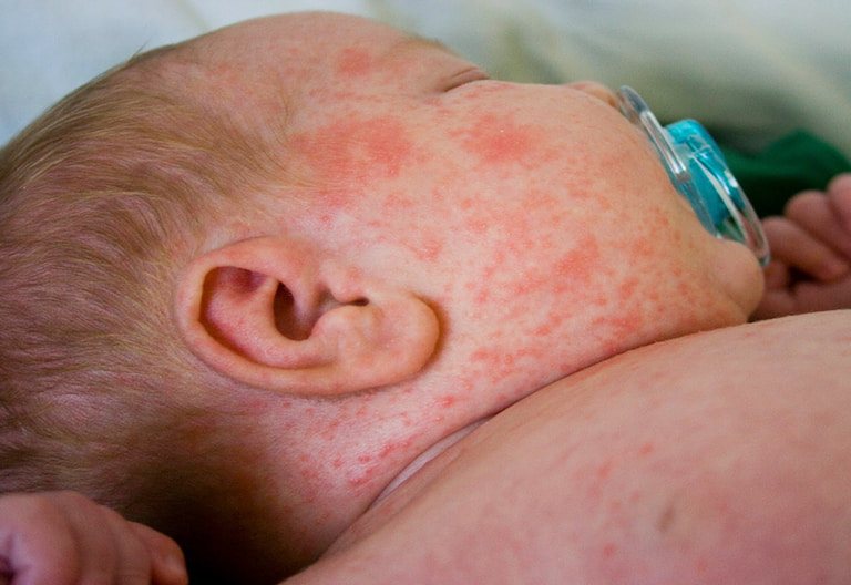 Sốt phát ban biểu hiện với tình trạng nóng sốt đi kèm xuất hiện các đốm đỏ trên da