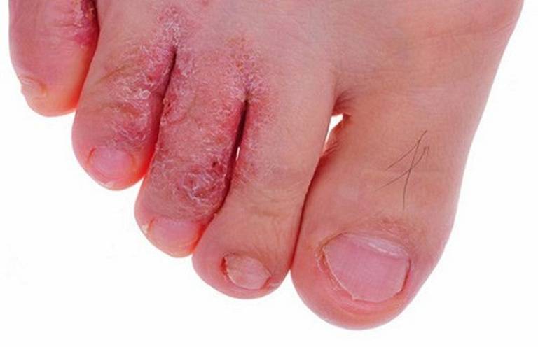 Bệnh tổ đỉa thường gây ra tổn thương tại tay, chân