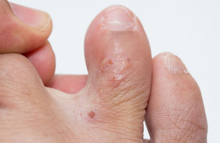 Bệnh tổ đỉa ở chân là gì?