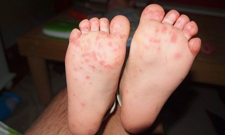 Bệnh tổ đỉa ở trẻ em là một thể của bệnh chàm - eczema