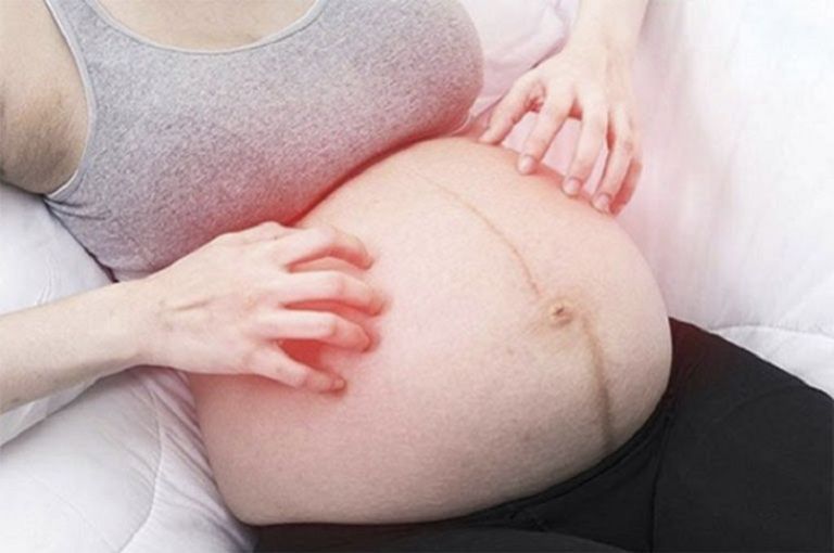 Mẹ bầu bị vảy nến khi mang thai thường rất lo lắng