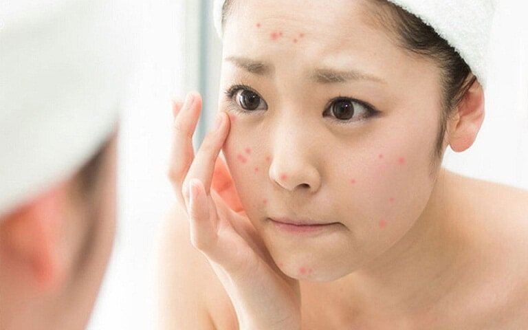 Một số lưu ý khi áp dụng cách chữa dị ứng da mặt tại nhà