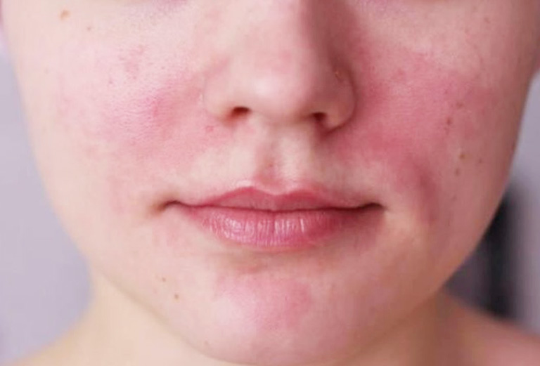 Dị ứng da mặt bao lâu thì khỏi sẽ tuỳ thuộc vào tình trạng bệnh