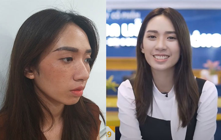 Hình ảnh trước và sau khi sử dụng Vương Phi xử lý nám của chị Thanh Vân