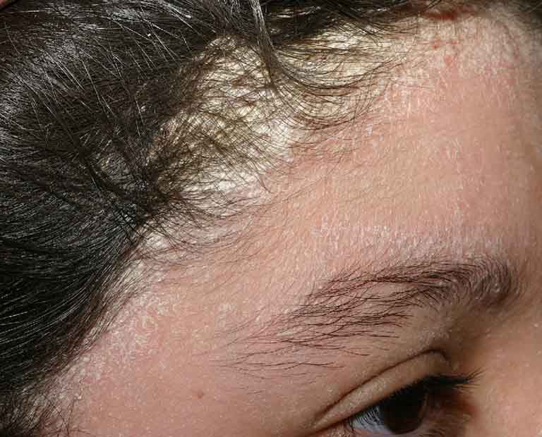 Vảy nến da đầu là một thể của bệnh vảy nến và khá phổ biến ở nước ta