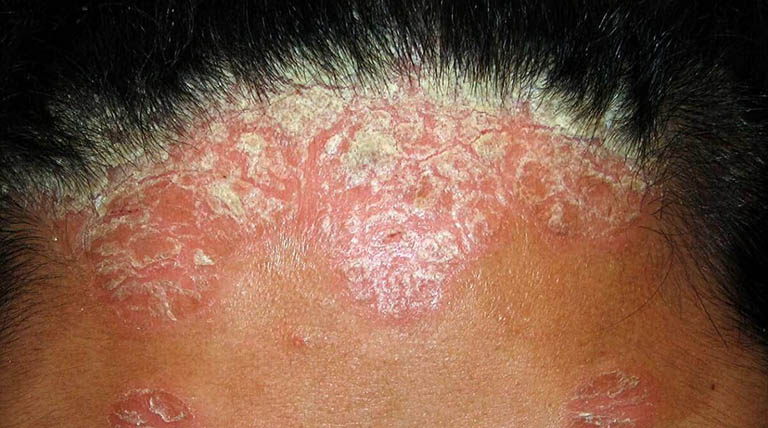 Rối loạn hệ miễn dịch có thể là nguyên nhân gây bệnh vảy nến da đầu