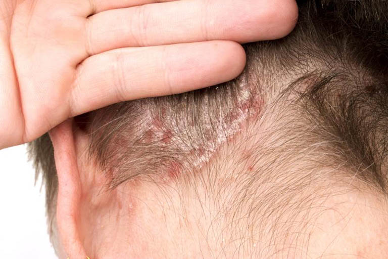 Bệnh vảy nến da đầu không lây nhiễm, có thể để lại biến chứng nguy hiểm