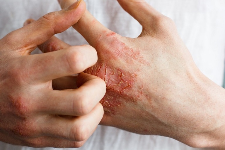Bệnh có thể tiến triển thành nhiễm trùng da nếu không được điều trị kịp thời
