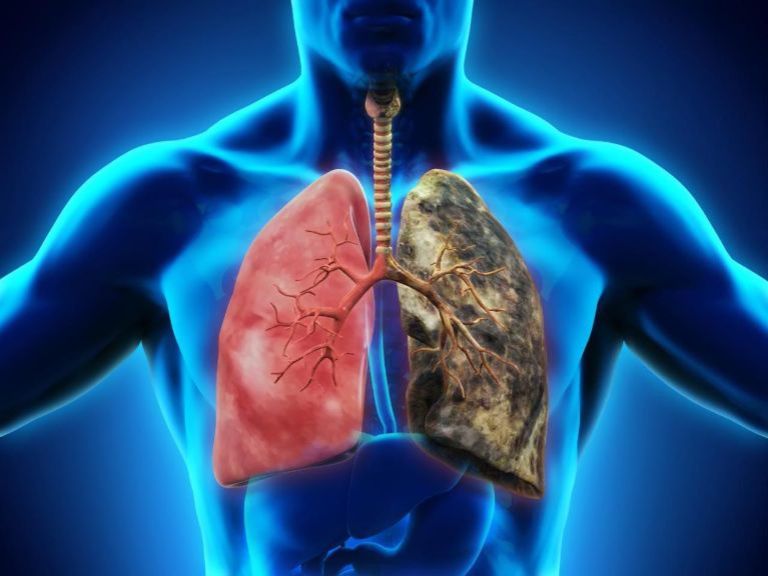 Vảy nến toàn thân nếu không được điều trị có thể dẫn tới viêm phổi