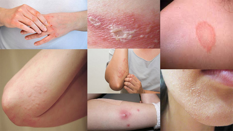 Có nhiều loại bệnh viêm da khác nhau
