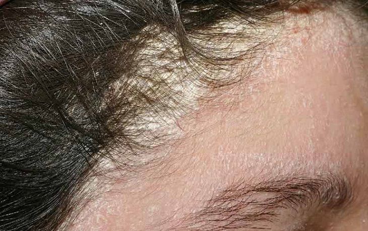 Viêm da tiết bã là tình trạng bong tróc, viêm ngứa ở da đầu