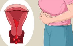 Lạc nội mạc tử cung là bệnh gì?
