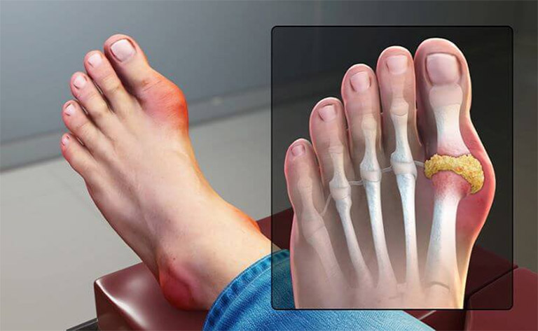 Thoái hóa khớp ngón chân gây đau nhức
