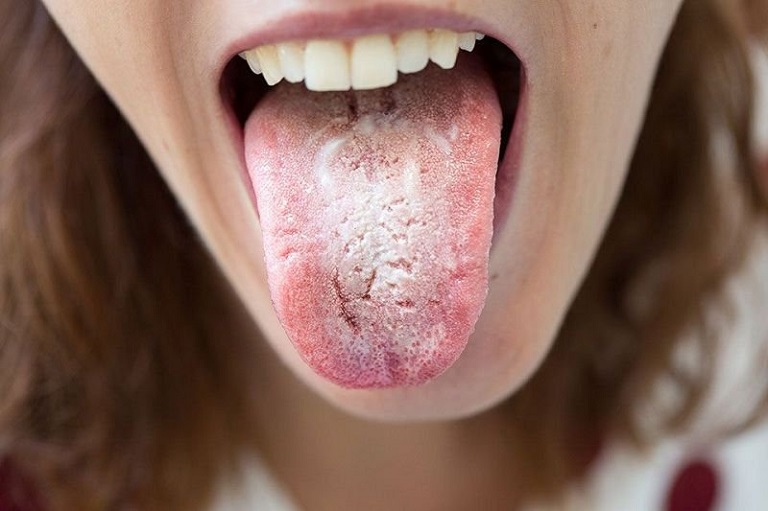 Trào ngược dạ dày lưỡi trắng là hiện tượng bề mặt lưỡi xuất hiện lớp rêu màu trắng kem do nấm