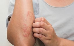 Viêm da tiếp xúc xảy ra khi tiếp xúc với các tác nhân gây dị ứng