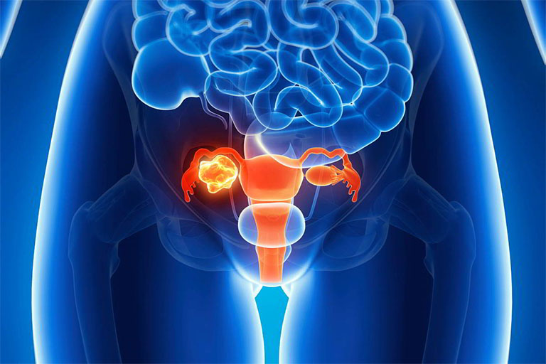 Viêm lộ tuyến cổ tử cung có nguy cơ cao dẫn đến ung thư