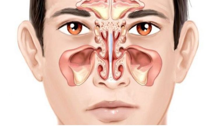 Viêm mũi dị ứng có thể gây ra viêm xoang