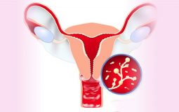 Viêm vùng chậu là bệnh lý viêm nhiễm đường sinh sản dễ gặp ở nữ giới