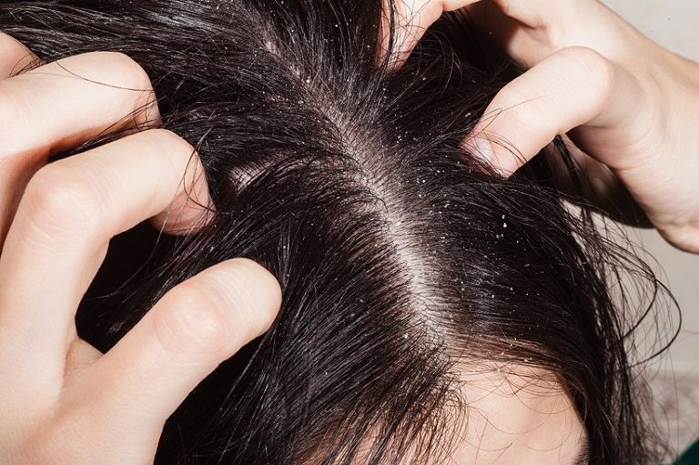 Viêm da đầu là bệnh da liễu xuất hiện trên da đầu