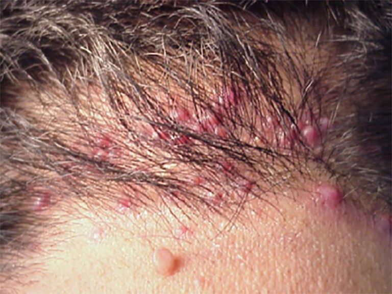 Viêm da đầu gây rụng tóc do viêm nang lông da đầu