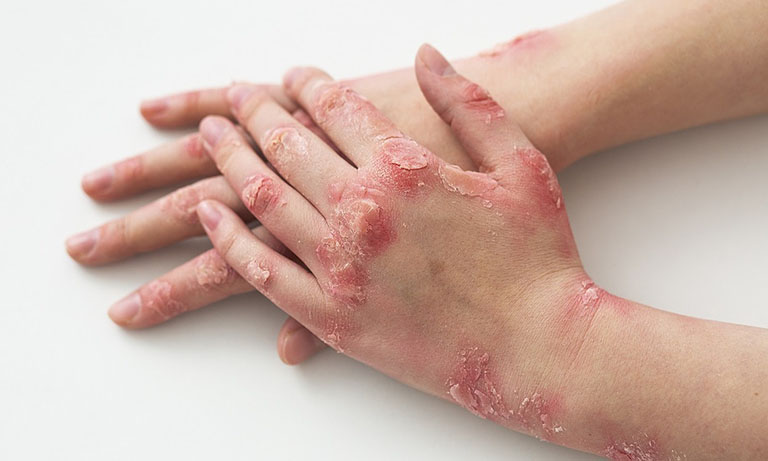 Nếu bị ngứa loét da, rất có thể bạn đang bị viêm da cơ địa