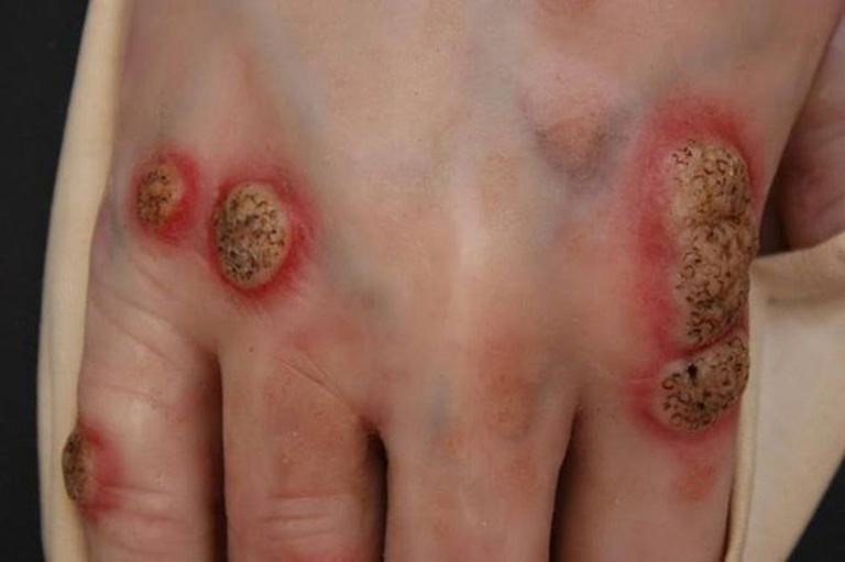 Bệnh lao da là tình trạng da bị nhiễm khuẩn mãn tính và khá hiếm gặp