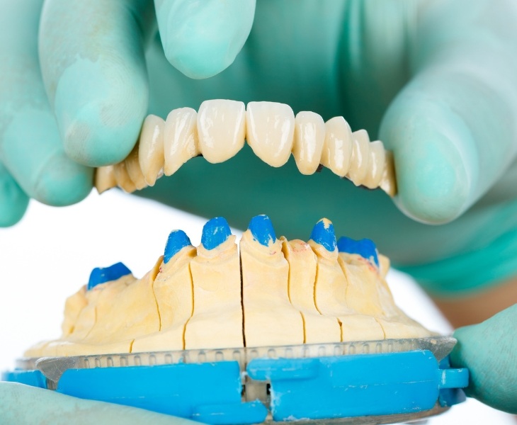 Quy trình bọc răng sứ an toàn - không đau - chuẩn y khoa tại ViDental Clinic