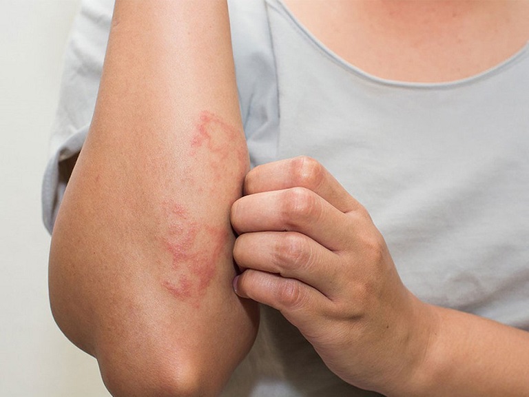 Viêm da tiếp xúc có để lại sẹo không là câu hỏi được nhiều người quan tâm