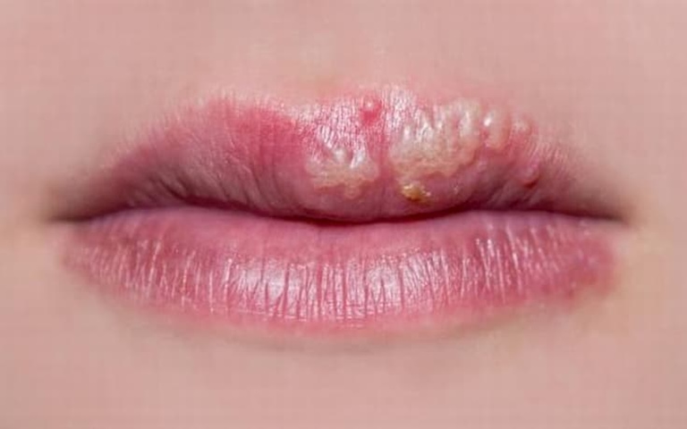 Ngứa môi có thể đi kèm các tổn thương khác như nổi mụn nước, mụn mủ