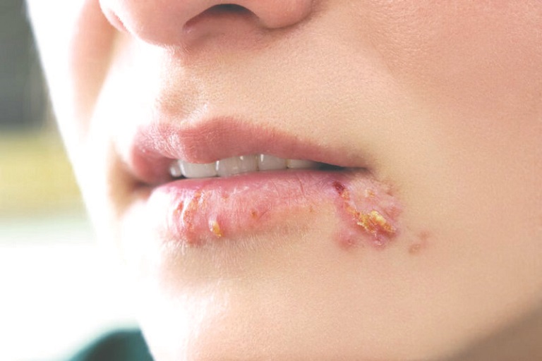Hình ảnh Herpes môi