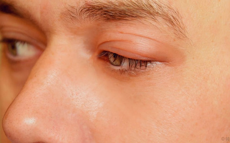 Vùng da quanh mắt khá mỏng nên dễ bị kích ứng và tổn thương