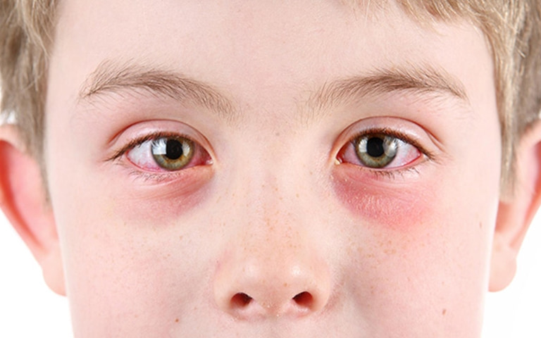 Viêm mô tế bào là tình trạng xung quanh mắt và trong mắt bị nhiễm trùng