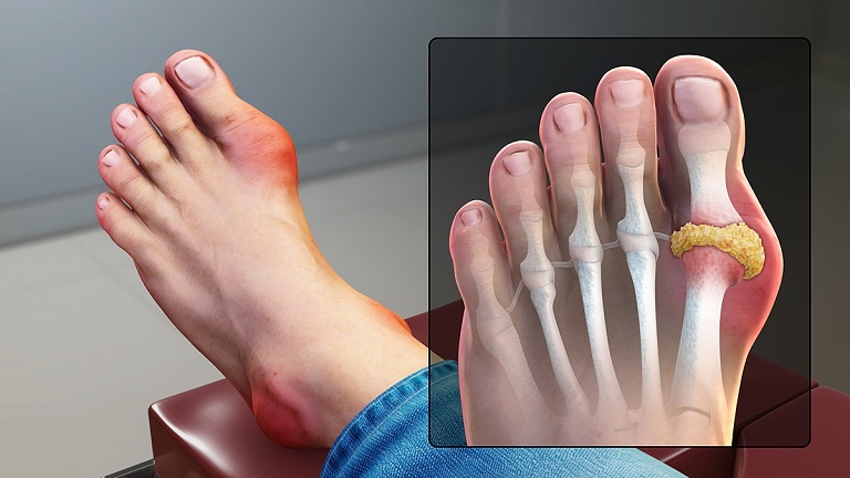 Bệnh gout gây ra những cơn đau ở vùng khớp ngón chân, ngón tay