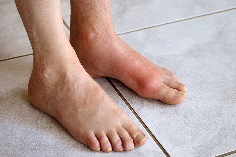 Bệnh gout là một dạng viêm khớp khá phổ biến thường gặp ở người trung niên