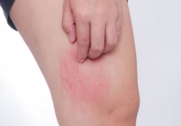 Hạn chế cào gãi da để tránh nguy cơ bị nhiễm trùng